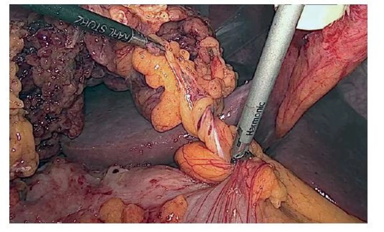 Stopka torze<br>
Fig. 2: Base of torsion