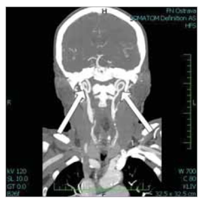Oboustranný coiling a. carotis
interna.<br>
Fig. 5. Bilateral coiling of the internal
carotid artery.