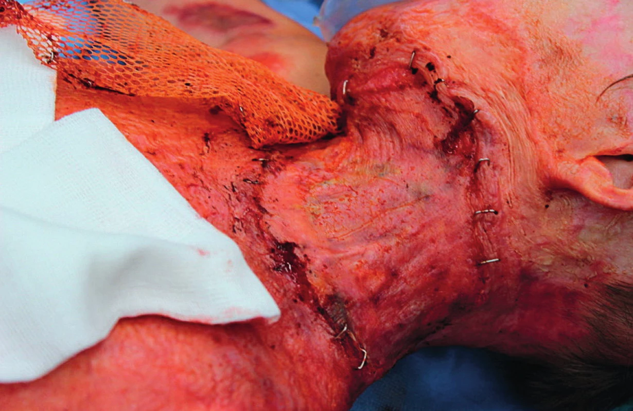 The defect with established dermo-epidermal graft 7 days after application