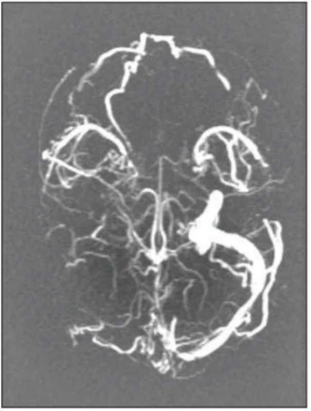 Trombóza mozkových žilních
splavů. Zobrazení MR mozkových žil, rekonstrukce maximum intensity projection – absence toku v sinus sagitalis superior, sinus transversus a sinus sigmoideus
vpravo. <br>
Fig. 3. Cerebral venous sinus thrombosis.
MRI venography, maximum intensity
projection reconstruction – the absence
of normal fl ow in the superior sagittal, right transverse and right sigmoid
sinuses.