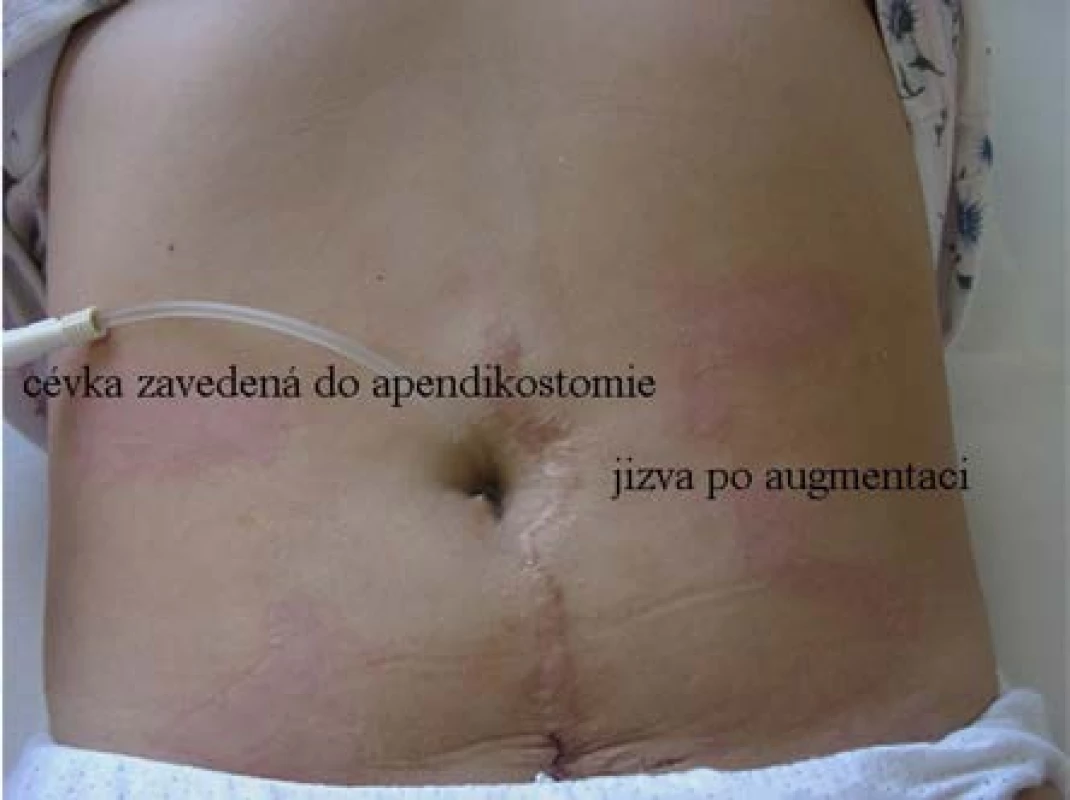 Pohled na břišní stěnu nemocné po augmentaci měchýře: jizva po střední dolní laparotomii, založená apendikostomie v pupku se zavedenou cévkou<br>
Fig. 2. View of the patient’s abdominal wall after
bladder augmentation: a scar after an inferior median laparotomy; appendicostomy created at the
umbilicus with a catheter in place