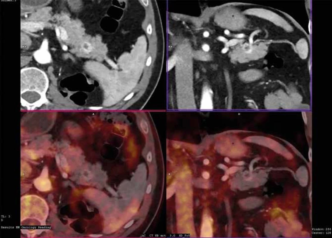 Metastáza světlobuněčného karcinomu ledviny do pankreatu v CT obraze<br>
Fig. 2: CT findings of clear cell renal carcinoma metastasis to the pancreas