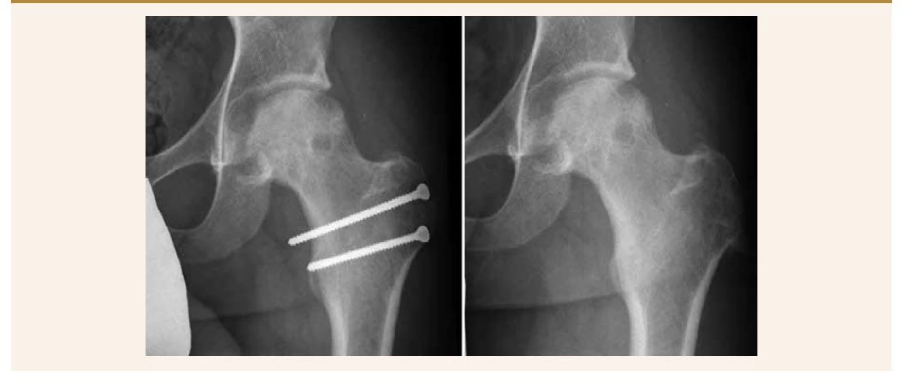 Vľavo: pacient pred extrakciou osteosyntetického materiálu. Vpravo: 12 mesiacov od operácie, po extrakcii
skrutiek.