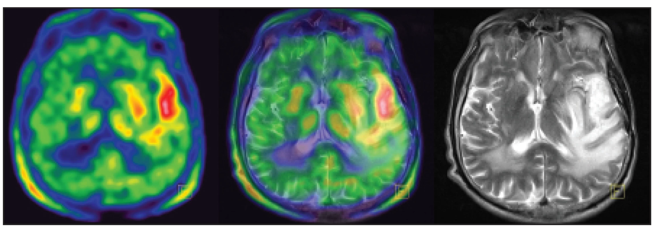 Pacient s glioblastoma multiforme temporálního laloku vlevo, po resekci tumoru. Lokální recidiva s vysokou akumulací
<sup>11</sup>C-methioninu.