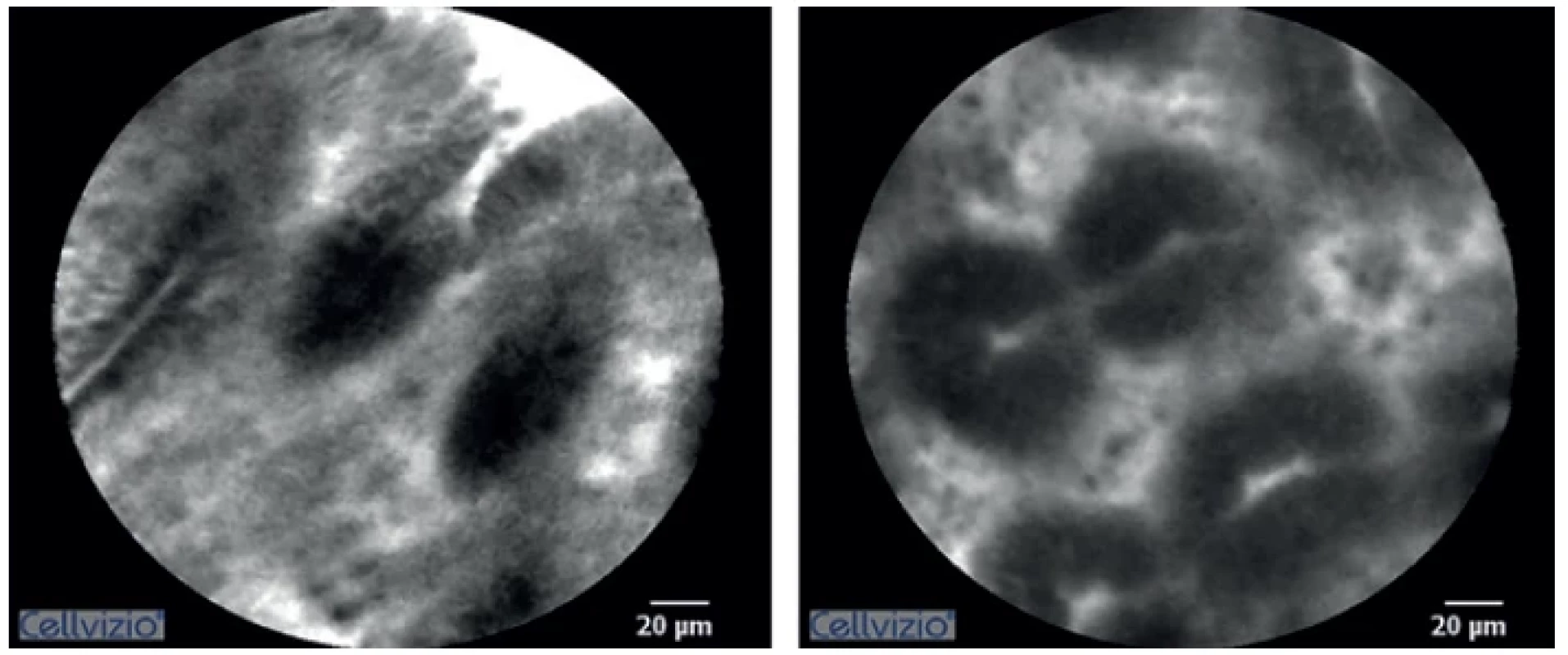 Confocal laser endomicroscopy imaging of ischemic colorectal anastomosis