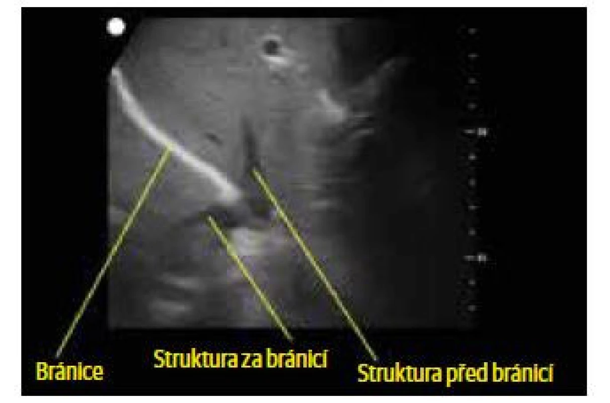Zrcadlení jaterního parenchymu za bránicí
– detail. Detailní zobrazení pomocí funkce
zoom nám ukazuje zrcadlení cévní struktury, která
se nachází před bránicí (myšleno mezi bránicí
a ultrazvukovou sondou), do prostoru za ní, tedy
dále od ultrazvukové sondy.