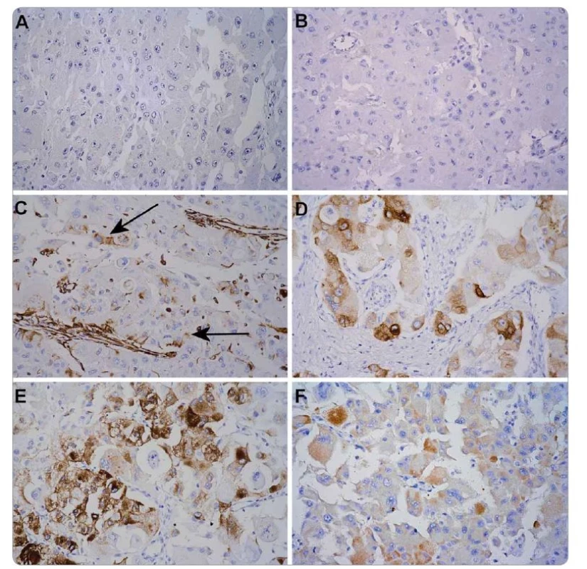 Immunohistochemical profi le of the tumor.
Tumor cells were negative for cytokeratins AE1/3 (A) and CD10 (B), focally positive for vimentin (C), and showed typical cytoplasmic positivity
for Melan A (D) and HMB45 (E). The cells showed also cytoplasmic MyoD1 (F) positivity reported in these tumors [15]. IHC-Px-DAB, 400×.