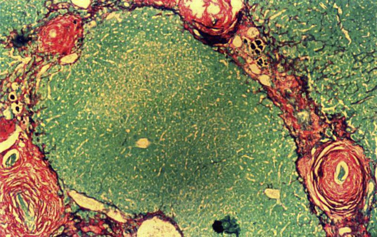 Perioválné granulomy kolem odumřelých vajíček
<i>Schistosoma mansoni</i>. Barveno <i>Picrosirius red</i>, jež barví
extracelulární matrix, zejména kolagen typu I a III, červeně,
živé buňky jaterního parenchymu zeleně.