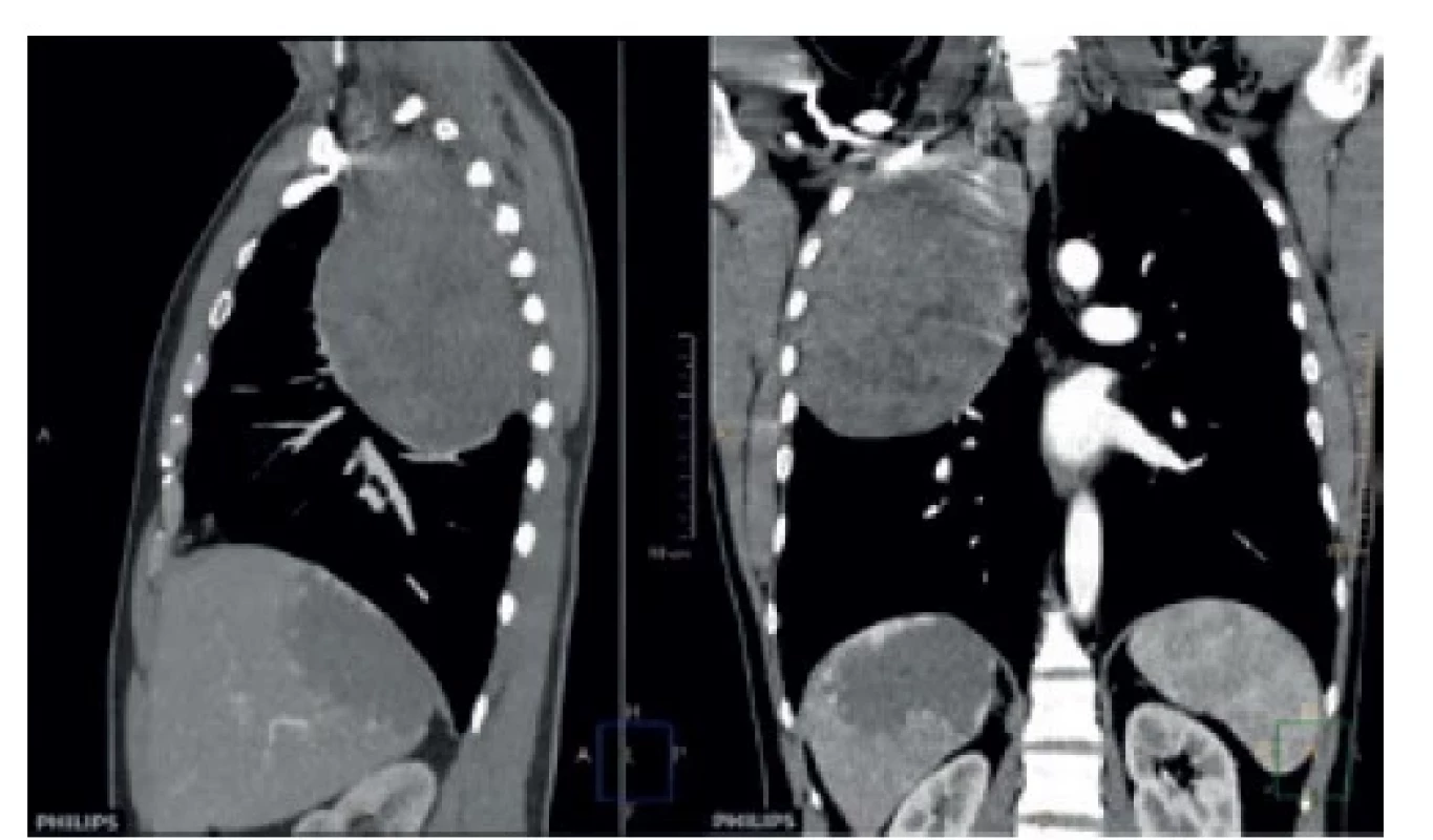 Solitárny fibrózny tumor v apikálnej časti pravej
pleurálnej dutiny (CT pracovisko NÚTPCHaHCH Vyšné
Hágy, Vysoké Tatry)<br>
Fig. 1: Solitary fibrous tumor in the apical part of the right
pleural cavity (CT department of NUTPCHaHCH Vysne
Hagy, Vysoke Tatry)