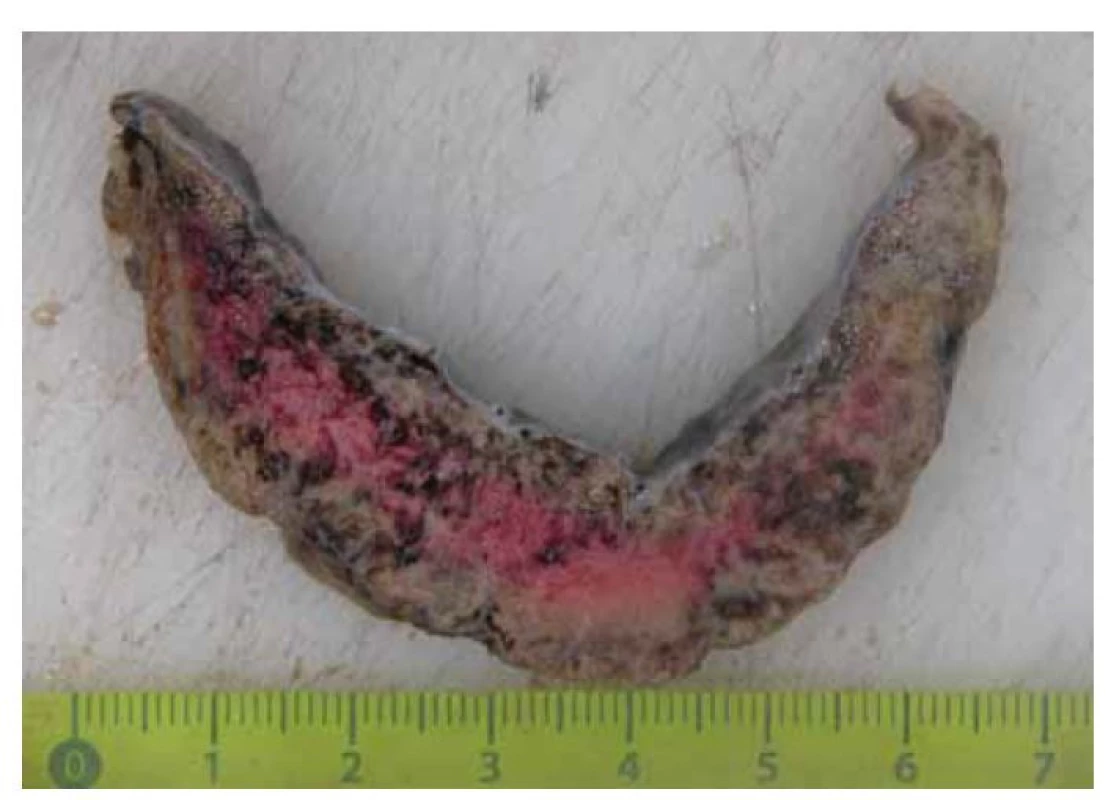 Případ č. 1. Placenta potraceného plodu (19+2) s neostře ohraničenými
šedožlutými ložisky odpovídajícími perivilóznímu fibrinoidu.<br>
Fig. 1. Case No. 1. Placenta of an aborted fetus (19+2) with voluminous irregular
grey-yellow foci corresponding to a perivillous fibrinoid.