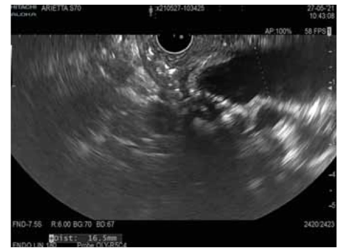 MD-IPMN.<br>
Fig. 1. MD-IPMN.