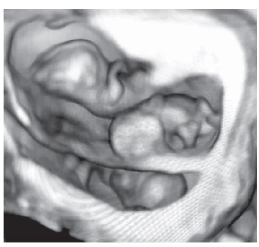 Ultrazvukový nález trojčat ve 3D – bichorální triamniální
trojčata (zdroj: publikováno se souhlasem Gynekologicko-
porodnického oddělení FN Olomouc).<br>
Fig. 5. Ultrasound find triplets in 3D – bichorial triamniotic
triplets (source: published with the consent of the Gynecology
and Obstetrics Department of University Hospital in
Olomouc).