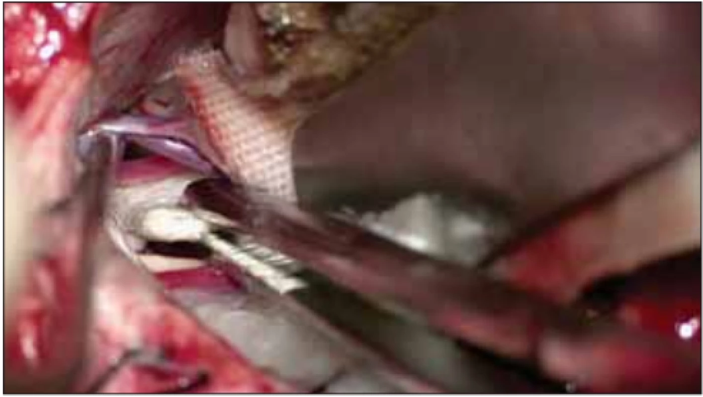 The superior petrosal vein, trigeminal nerve and superior
cerebellar artery, which create pressure on the trigeminal nerve,
are seen in the dissection during surgery.<br>
Obr. 3. Během operace je na řezu vidět vena petrosa superior, trojklanný nerv a arteria cerebelli superior, která tlačí na trojklanný nerv. 