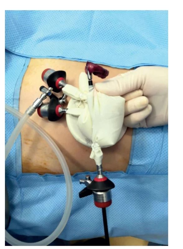 Extrakce resekovaného apendixu cestou SILA portu<br>
Fig. 6: Extraction of resected appendix via SILA port