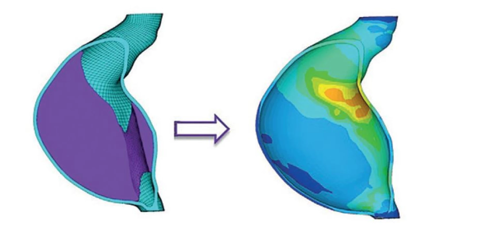 Analýza napětí cévní stěny<br>
Fig. 4: Vascular wall stress analysis
