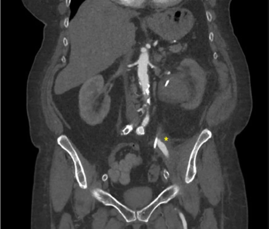 Tekutinová kolekce v okolí bypassu<br>
Fig. 1. Fluid collection surrounding bypass