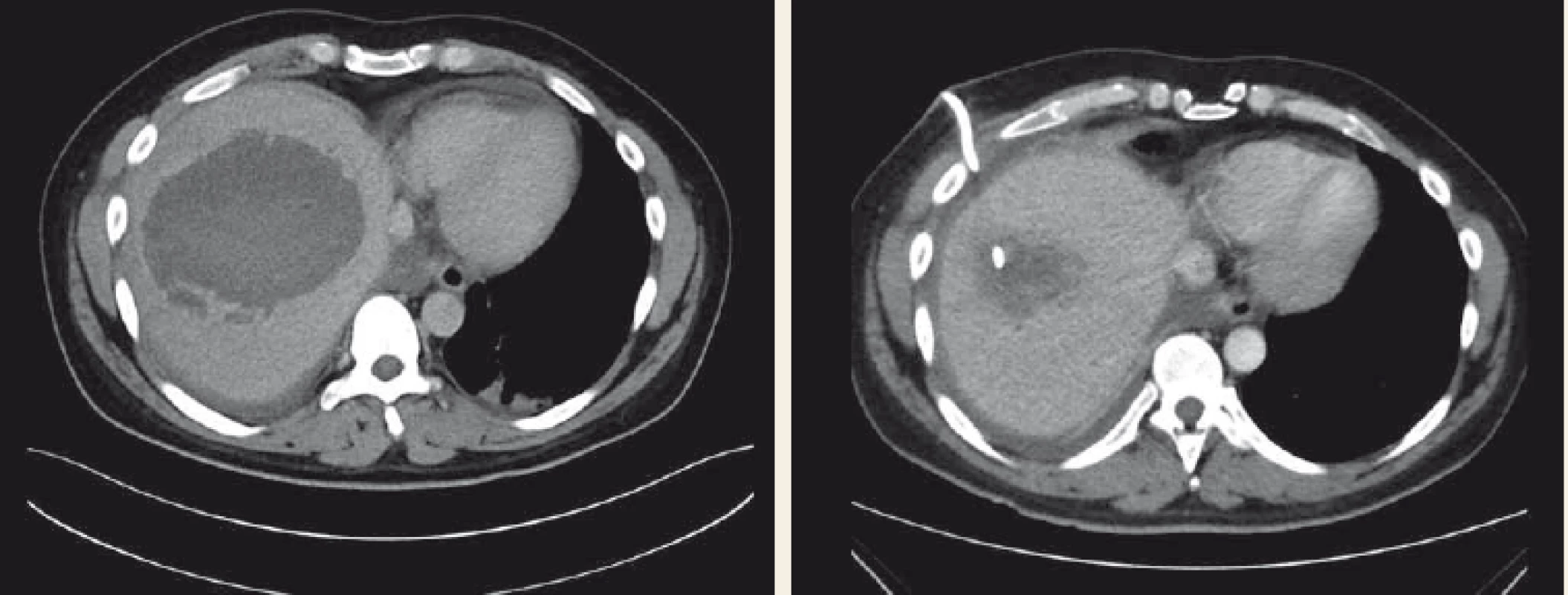 CT vyšetření – amébový absces jater úspěšně léčený perkutánní drenáží a systémovou antimikrobiální terapií.<br>
Fig. 1. CT scan – amoebic liver abscess successfully treated with percutaneous drainage and systemic antimicrobial therapy