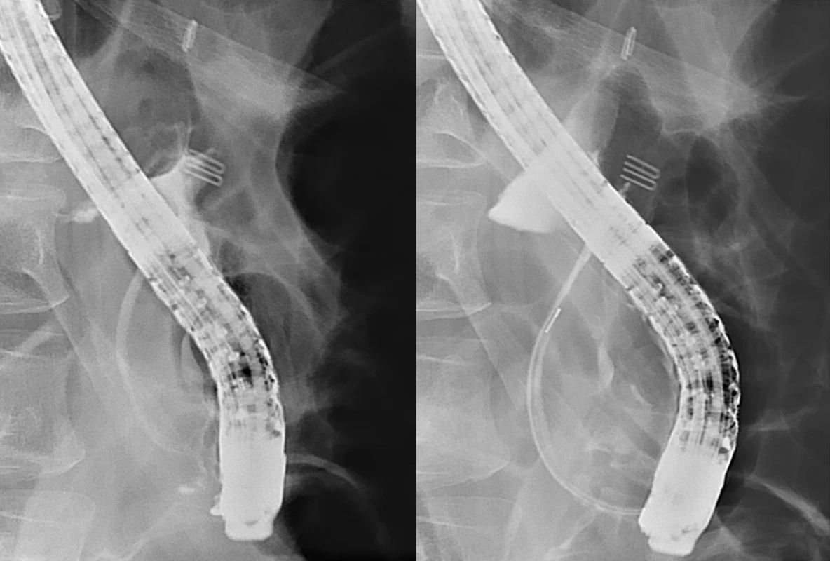Partial cut-off of the contrast medium, 7 cm above
the ampulla of Vater, with a  simultaneous massive leak
on the ERCP