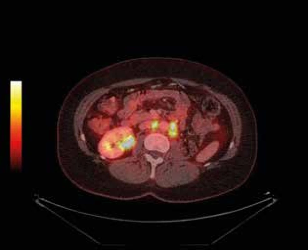 Pokročilý uroteliální karcinom pánvičky levé ledviny s lymfadenopatií – PET CT (restaging) <br>
Fig. 9: Advanced urothelial carcinoma of the renal pelvis of
the left kidney with lymphadenopathy – PET CT ( restaging)