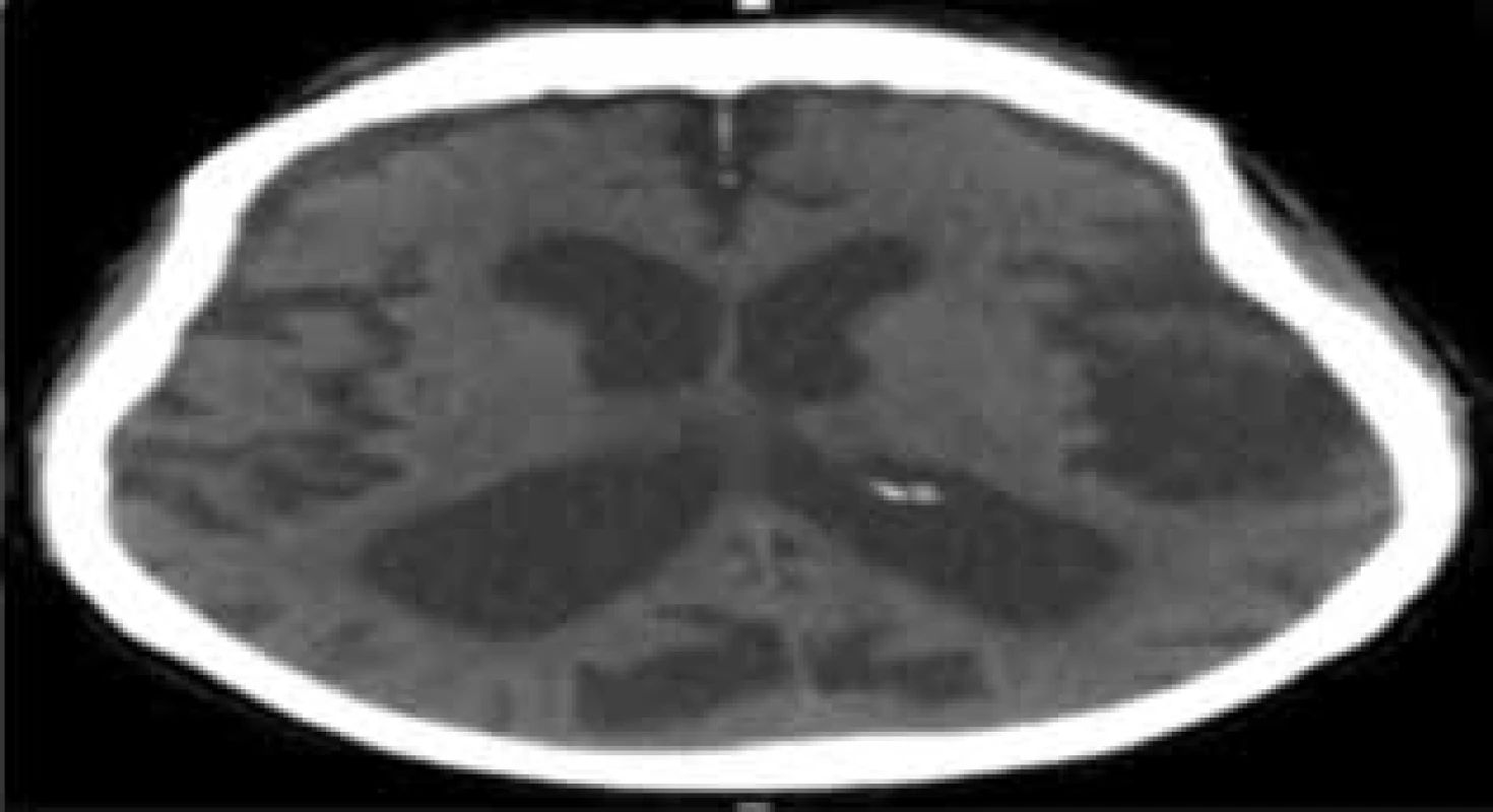 CT snímek pacienta s atrofií mozkovou
Rozšířená Sylviova rýha a subarachnoideální prostory se
širšími postranními komorami, bez periventrikulárního
prosaku likvoru.<br>
Fig. 1: CT image of a patient with cerebral atrophy
Widened Sylvian fissure and subarachnoid spaces with
enlarged lateral ventricles, without transependymal edema.