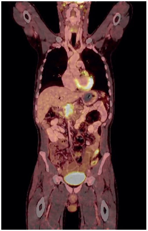 PETCT – progredující neodstranitelná masa hlavy
pankreatu <br> 
Fig. 6. PETCT – progression of an inoperable tumor in the
head of the pancreas