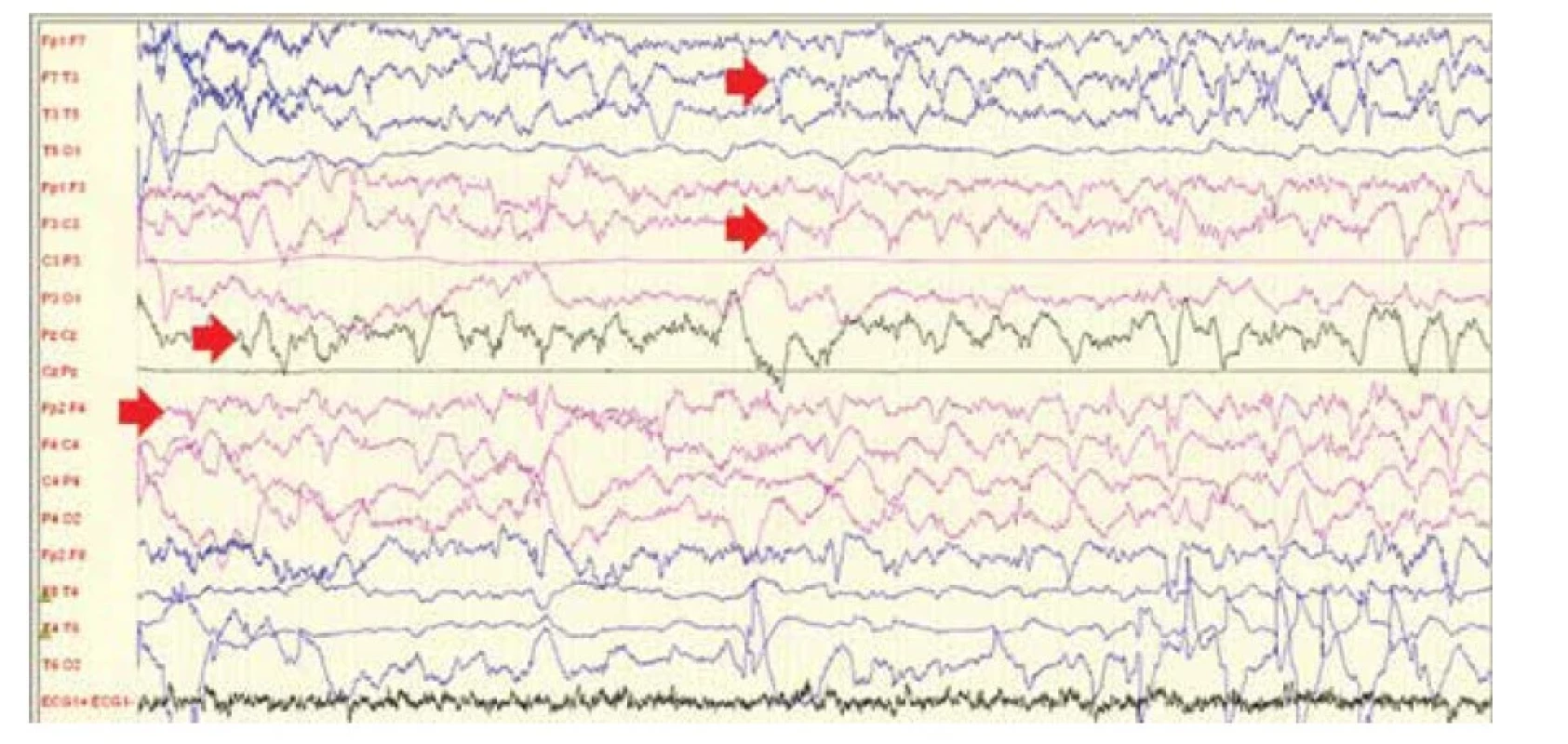a Elektroencefalografický záchvat zachytený na cEEG: prítomná evolúcia epileptiformných grafoelementov
v lokalizácii – v úvode F vpravo (prvá šípka zľava), následne šírenie k stredočiarovým elektródam (druhá
šípka) a do ľavej hemisféry (tretia a štvrtá šípka)