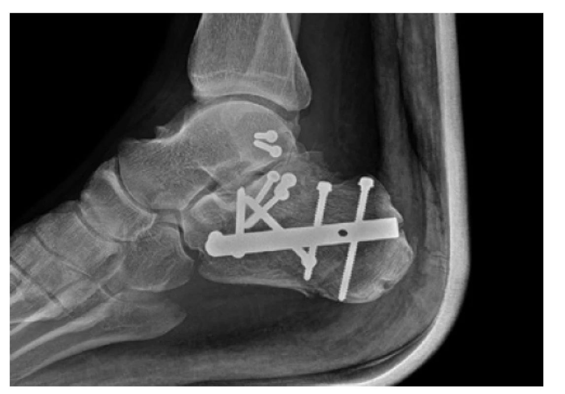 Rentgenový snímek osteosyntézy kalkanea nitrodřeňovým
hřebem C-Nail (Medin) a refixací kostěnné
avulze horního peroneálního poutka 2,7mm šrouby<br>
Fig. 5: Postoperative X-ray of calcaneal intramedullary
nailing using the C-nail (Medin) with refixation of superior
peroneal retinaculum using 2.7 mm screws