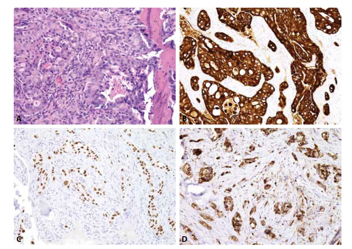 Metastáza nemalobuněčného karcinomu plic. A) struktury adenokarcinomu (H&E); B) cytoplazmatická exprese CK7; C) jaderná exprese
TTF-1; D) cytoplazmatická exprese Napsin A (vše zvětšení x200).