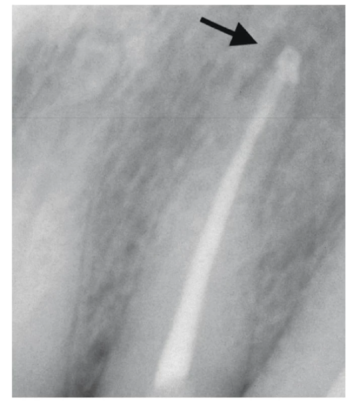 RTG snímek bezprostředně po zaplnění s extruzí materiálu do periodoncia <br>
Fig. 11 X-ray image immediately after root canal filling with extrusion of material into the apical periodontal area