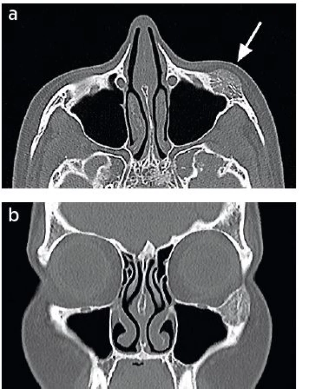 a, b. The CT scan shows a lesion in the left zygoma sized
23 x 19 x 14 mm. The corticalis is thinned; the surrounding soft
tissues are unaltered (arrow)