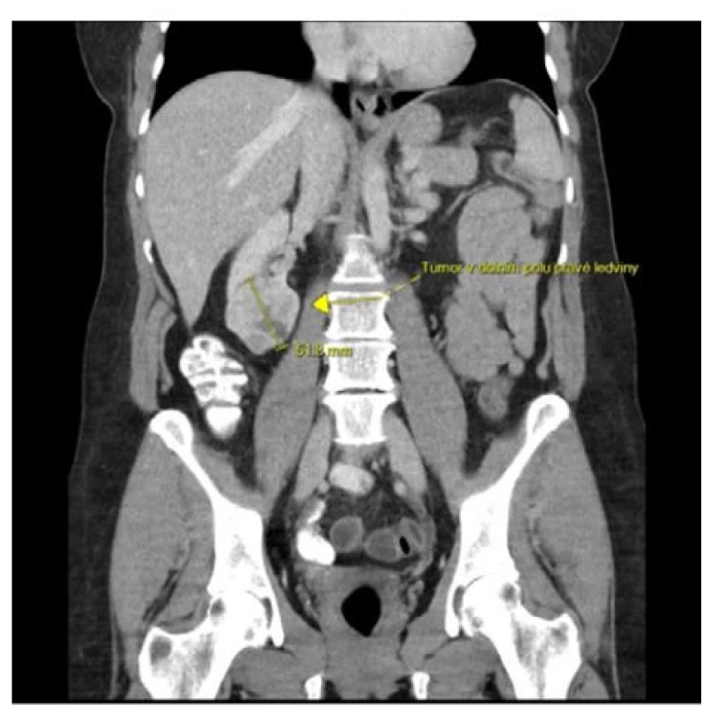 CT s kontrastní látkou, venózní fáze, koronární
řez: částečně nekrotický tumor dolního pólu pravé
ledviny velikosti 5 cm; zdroj: Radiologické oddělení
Nemocnice Most<br>
Fig. 2. Contrast-enhanced CT, venous phase, coronary
section: partially necrotic tumor of the lower
pole of the right kidney with a size of 5 cm; source:
Department of Radiology, Most Hospital