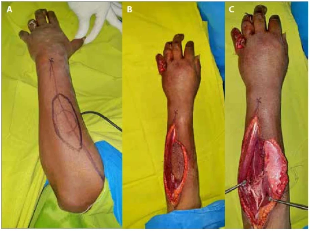 (A) Marking of the flap; (B,C) flap after being harvested.