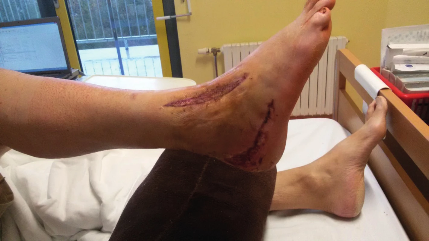 Odlehčující kožní incize na nártu s již přihojeným kožním štěpem.
Rozvoj nekrózy a defektu v operační ráně