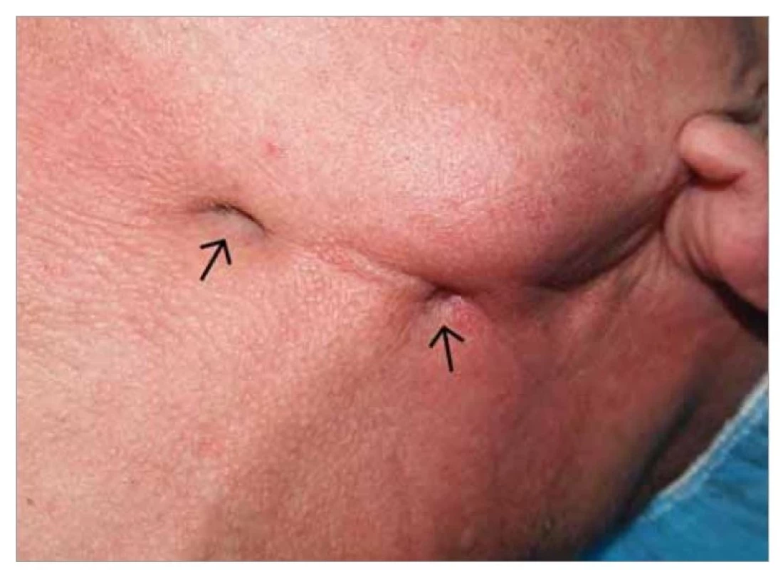 Submandibulární zduření se dvěma kožními píštělemi (šipky).<br>
Fig. 1. Submandibular swelling with two skin fistulas (arrows).