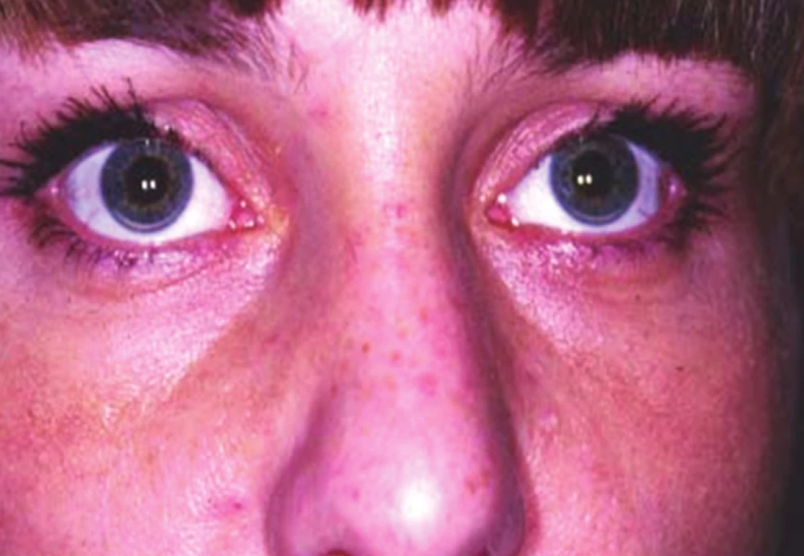 Arcus lipoides corneae obou očí (z archivu Centra preventivní
kardiologie III. interní kliniky VFN v Praze)