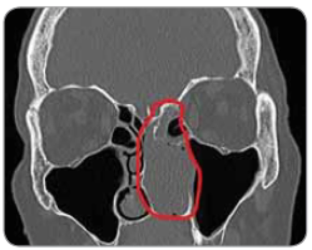 Obr. 3. CT snímka – trupová koronárna
projekcia.