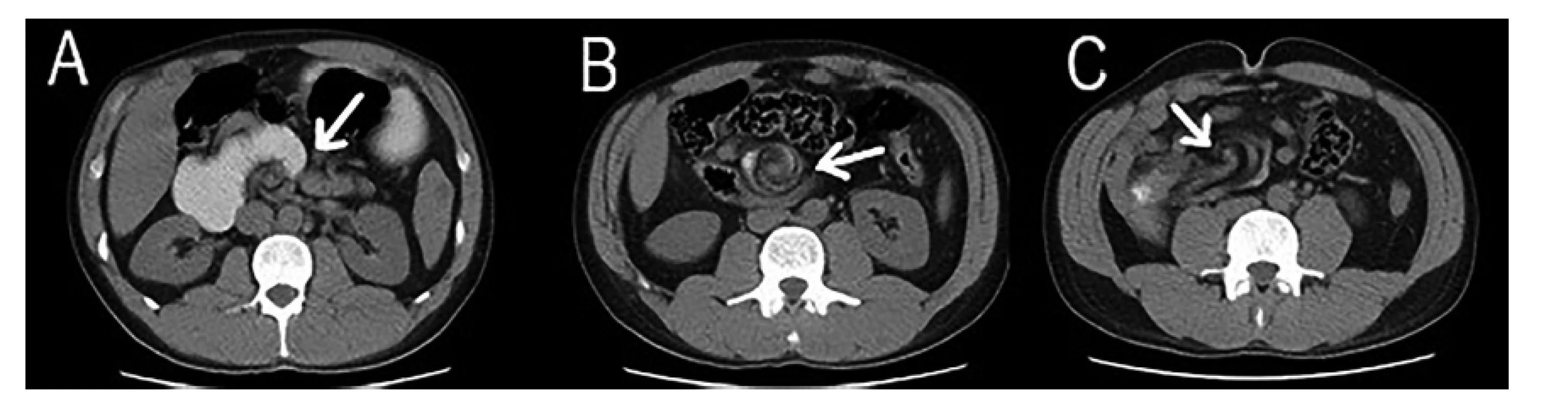 CT břicha<br>
A − Viditelná přechodová zóna v oblasti duodenojejunálního přechodu; B a C − příznak víru (whirlpool sign).<br>
Fig. 1: CT of the abdomen<br>
A − Visible transient zone in the area of the duodenojejunal junction; B and C − the whirlpool sign.
