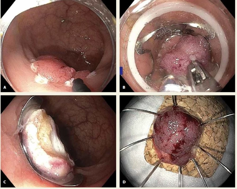 A. Lokální reziduální neoplazie rekta, v okolí patrné koagulační body k označení zdravých okrajů léze; B. vtahování léze do „capu“ s nasazeným OTS klipem speciálními kleštěmi zavedenými pracovním kanálem koloskopu; C. nasazený OTS klip s příznakem terče („target sign“) indikující správně provedenou transmurální resekci; D. resekát našpendlený na korkovou podložku, histologické vyšetření prokázalo R0 resekci tubulovilózního adenomu s HGIN.<br> Fig. 1. A. Local residual neoplasia (LRN) in the rectum, coagulation marks evident around the lesion; B. pulling the lesion into the cap with an over-the-scope (OTS) clip using a grasper introduced through the working channel of the colonoscope; C. OTS clip with target signindicating a correctly completed transmural resection; D. specimen pinned on a cork board, histology showed completely resected tubulovillous adenoma with high-grade dysplasia