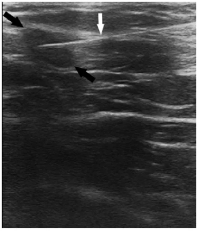 UZ obraz jehly (bílá šipka) zavedené do lymfatické
uzliny (černé šipky) <br> 
Fig. 1. Ultrasound image of needle (white arrow) inserted
into the lymph node (black arrows)