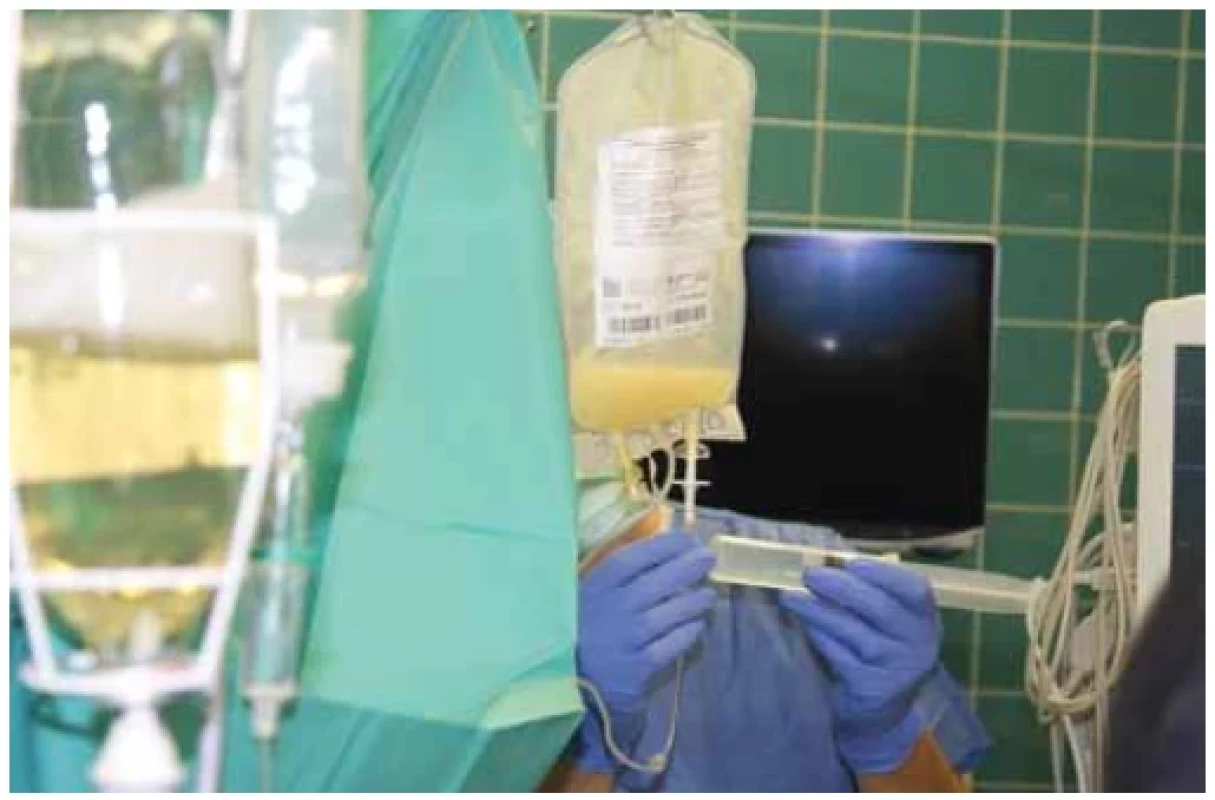 Podávanie suspenzie Langerhansových ostrovčekov peroperačne. <br> 
Fig. 6. Administering of a Langerhans islets suspension intraoperatively.