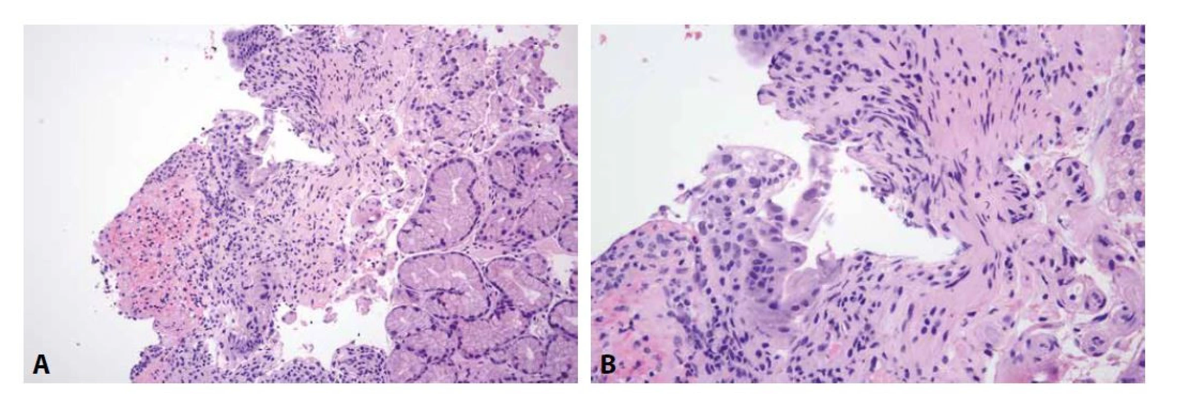 Cytomegalovirová duodenitida.
