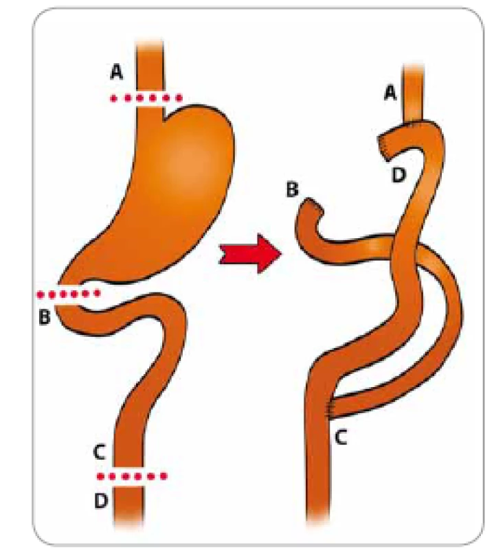 Gastric adenocarcinoma and pro -
ximal polyposis of the stomach – total
gastrectomy with subsequent reconstruction
of the digestive tract (Masaryk
Memorial Cancer Institute).