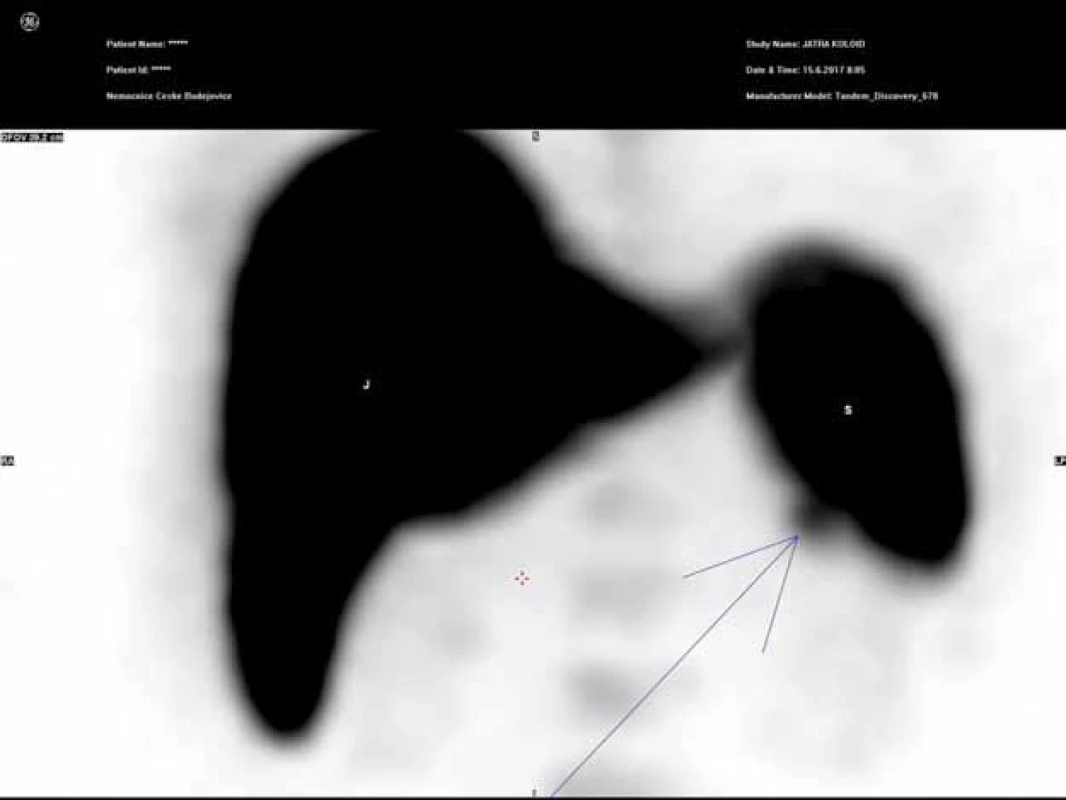 Tc-99m SPECT 3D – intrapankreatická akcesorní slezina (IPAS).
S – slezina, J – játra
Fig. 7. Tc-99m SPECT 3D – intrapancreatic accessory spleen (IPAS).
S – spleen, J – liver