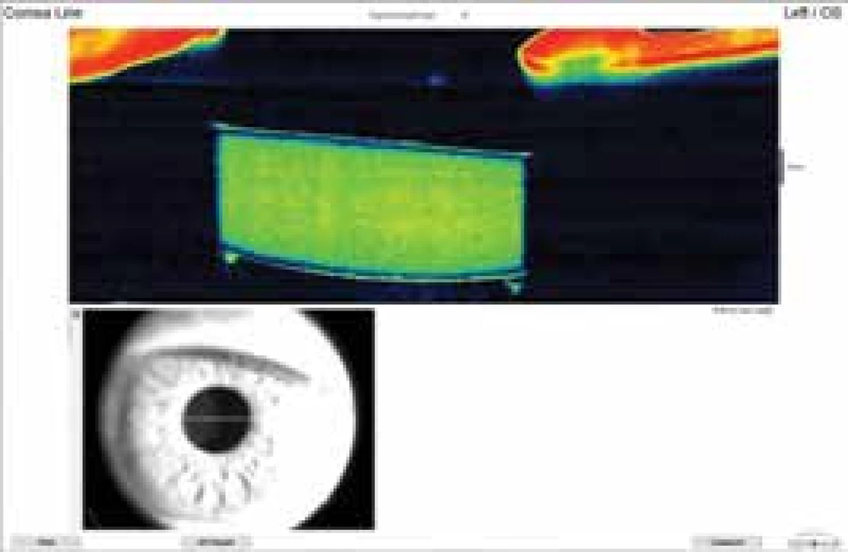 Anterior segment OCT – opacified IOL AcryNovaTMPC
610Y before explantation