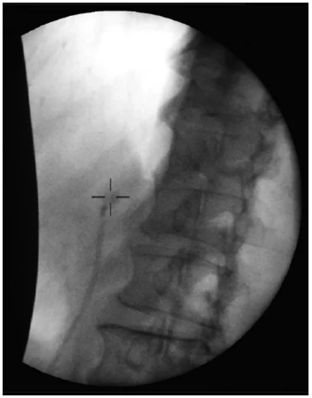 Fluoroscopy image from the first session of extracorporeal
shockwave lithotripsy – pancreatic duct stone
within the target cross
