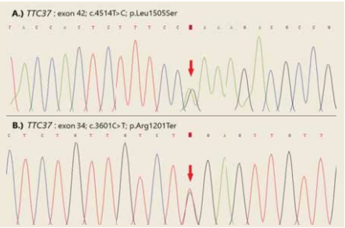 Confirmation of TTC37 variants by Sanger sequencing.<br>
Obr. 2. Potvrzení variant TTC37 metodou Sangerova sekvenování.
