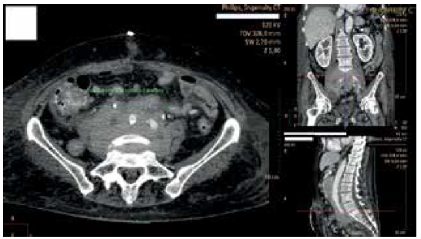 Oblast výstupu stentu z ureteru<br>
Fig. 2. Double J stent exit point from the ureter
