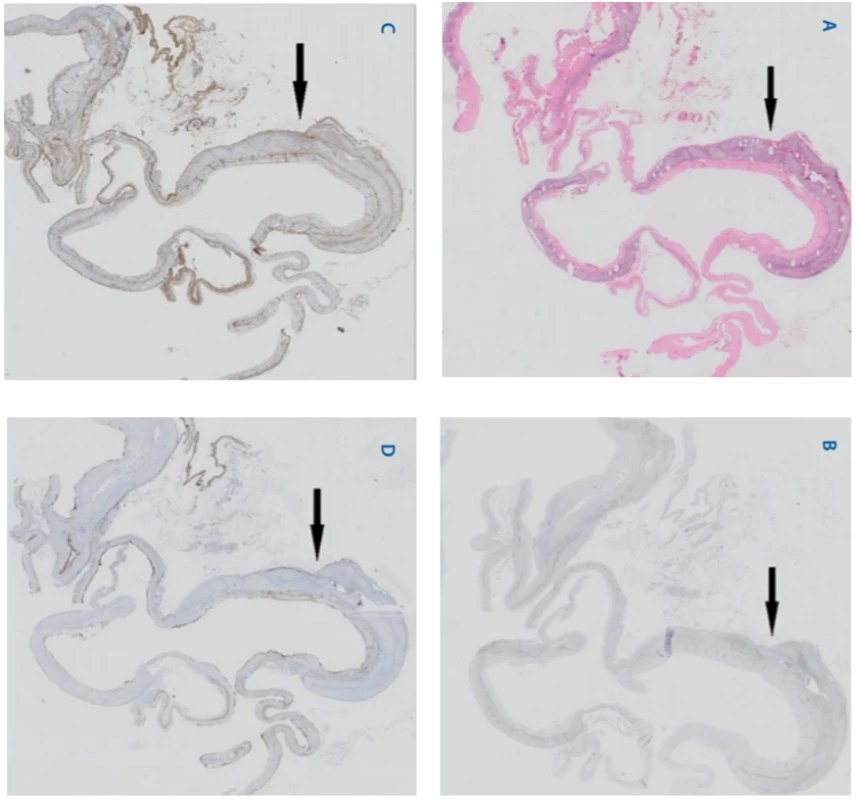 A–D. Histologické vyšetření ukazuje vazivovou stěnu cysty s ložiskovými hemoragiemi, posthemoragickými změnami a dystrofickými kalcifikacemi, která je lemovaná plochým, místy reaktivně
změněným endotelem bez atypií. Na stěnu cysty přímo neléhá patologicky nezměněná tkáň nadledviny (šipka). Endotelie jsou D2-40 pozitivní a CD34 a calretinin negativní, tento imonofenotyp je typický pro
lymfangiom. A – barvení hematoxylinem a eosinem, B – barvení calretinin, C – barvení CD34, D – barvení D2-40.<br>
Fig. 2A–D. Histological examination shows the cystic wall of the cyst with focal haemorrhages, posthemorrhagic
changes and dystrophic calcifications, which is flanked by a flat, locally reactive altered endothelium without atypia.
Residual adrenal structures without pathologic findings are located adjacent to cyst wall (arrow). The endothelium is
D2-40 positive, CD34 and calretinin negative. Such an ímmunophenotype is typical for lymphangioma. A - staining
with Hematoxyline and Eosin, B – staining with calretinin, C – staining with CD34, D – staining with D2–40. Ronal unenhanced T1 weighted image, B – coronal contrast-enhanced T1 weighted image, C – axial unenhanced T1 weighted
image, D – axial contrast-enhanced T1 weighted image.