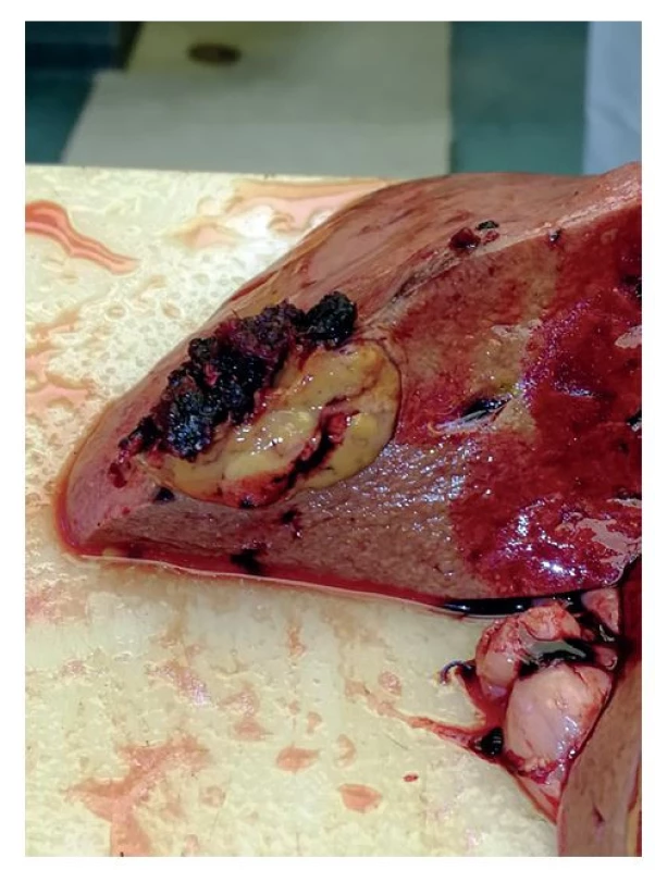 Sekční nález: karcinom na facies diaphragmatica<br>
Fig. 1: Autopsy finding: carcinoma on facies diaphragmatica