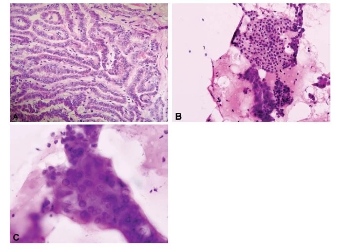 Porovnání peroperační „scrape“ cytologie a kryostatového
histologického řezu. (A) Ačkoli v některých případech mohou
být jaderné znaky papilárního karcinomu přítomny i v kryostatových
řezech (HE, 200x), (B, C) v peroperačních cytologických
preparátech získaných seškrabem tkáně z řezu nádorem jsou
obvykle výrazněji vyjádřena opticky prázdná jádra, jaderné pseudoinkluze
i jaderné zářezy (B, HE, 200x; C, HE, 400x).